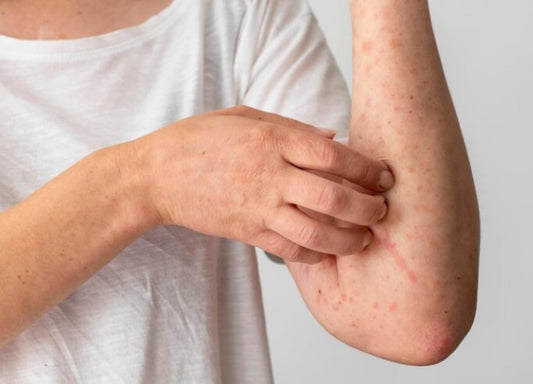Qué es la queratosis pilaris y cuáles son sus síntomas